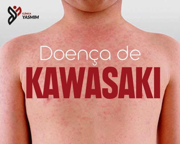 imagem de criança branca, sem camisa, com o texto Doença de Kawasaki escrita acima
